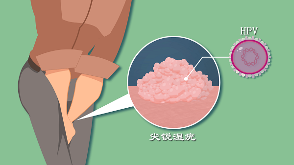 尖锐湿疣的原因是什么?