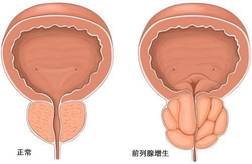 南京邦德中医院治疗前列腺增生患者满意
