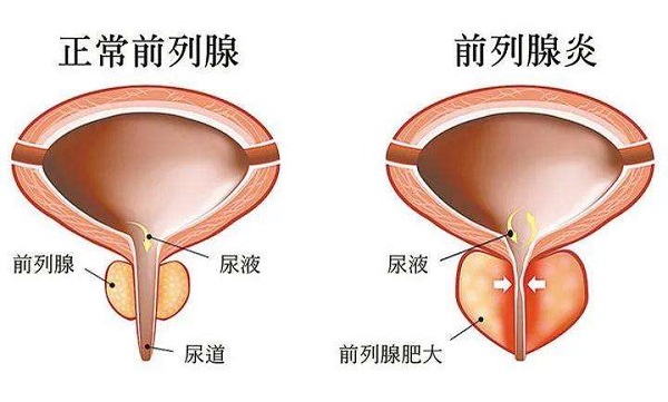 平时该如何预防前列腺方面的疾病呢?