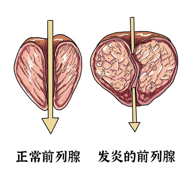南京邦德医院解答:前列腺炎的危害有哪些?