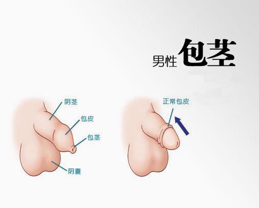 南京邦德男科医院解答:男性的包皮包茎具体存在哪些症状?