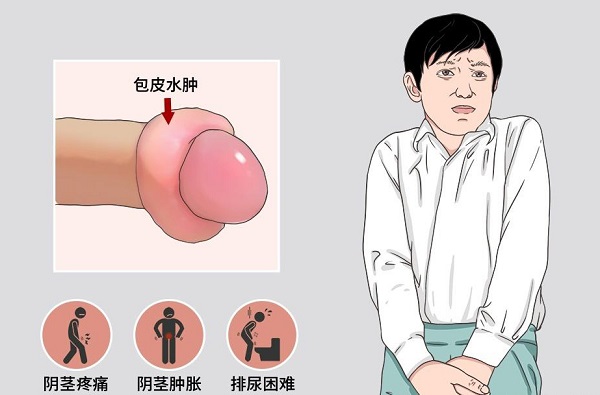 南京邦德中医院解答:男性出现包皮水肿怎么办
